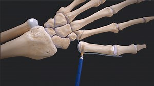 CMC Suspensionplasty Using the FiberLock™ Suspension System