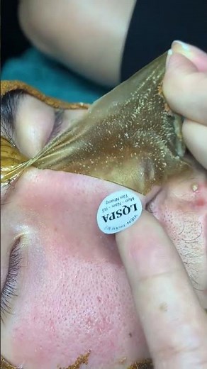 Deep Nose Blackhead Removal 😱 | Super Satisfying Skin Cleaning