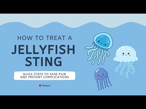 How to treat a jellyfish sting