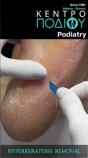 Hyperkeratosis Removal|Αφαίρεση Σκλήρυνσεων Πτέρνας|Κέντρο Ποδιού Podiatry|Podiatrist|Podologia|Foot