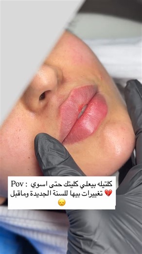 ‎Dr_Duaa Hameed د.دعاء حميد‎ on Instagram‎: "ليش هيجي 💔🤣 #explorepage✨ #اكسبلور #explorer #reels #lipfiller #explore #filler #reel #اكسبلور_فولو #lip"‎