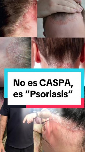 Understanding Psoriasis: Causes, Symptoms, and Treatment Options
