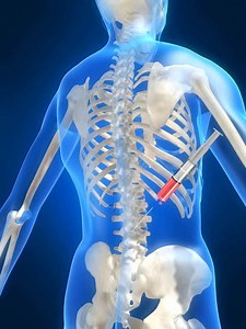 Hip Injections | Pain and Spine Specialists