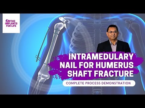 Intramedullary Nail For Humerus Shaft Fracture Procedure