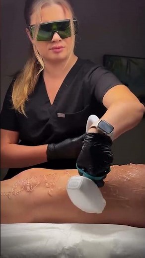 Laser hair removal