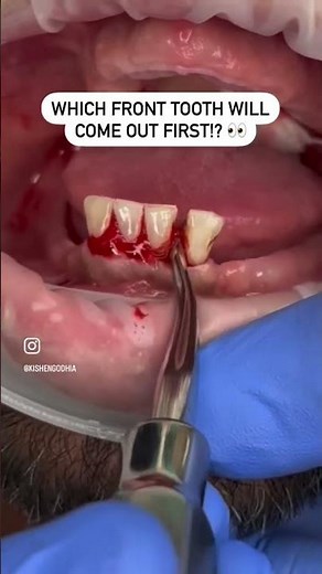 Extracting Lower Front Teeth?! #shorts