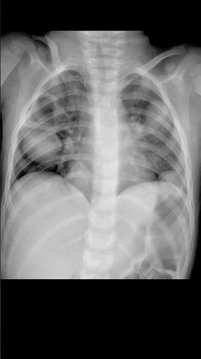 Multiple Cannonball Lung Lesions on Chest X-ray #shorts