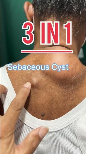 Lipoma Sebaceous cyst and Pigmented mole