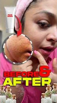 Part 2 – ഫേസ് വാഷ് ഉപയോഗിച്ച ശേഷം 3 ദിവസത്തിന് ശേഷം സംഭവിച്ചത് #trending #viral #shorts #pimples