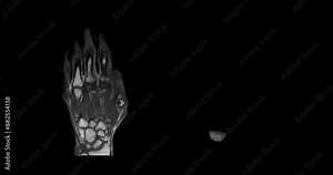 Footage of an MRI hand scan displays comprehensive views for diagnosing hand tumor diseases.