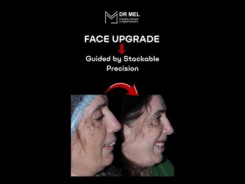 stackable guided surgery - teeth in day