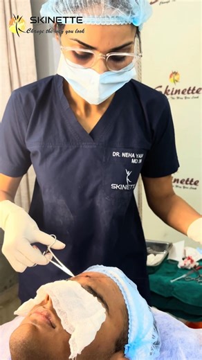 Forehead Sebaceous Cyst Removal Surgery Safe & Minimal Scar Procedure by Dr. Neha Yadav