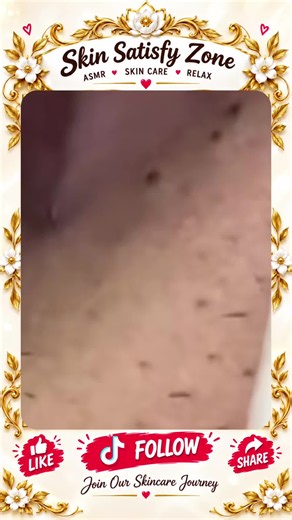 Deep Blackhead Extraction & Satisfying Popping | Wait for the most satisfying pop 😳🫣 You won’t believe what comes out! #pimplepoppersatisfying #Acne #pimple #Blackhead #Satisfying