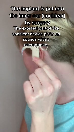 Understanding How Cochlear Implants Work