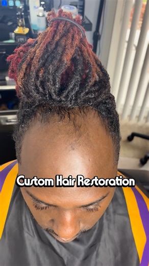 Atif Davis on Instagram: "Follow @mxl_mal @magic_bootcamp for more! (Jan 25th Philly n person💈class Book ur spot. Limited slots available) Hair Unit Install type: Custom Scalp Exposure (Natural text) Hair Adhesive: @boldholdlaceproducts Hair Vendor: www.mxlallstars.com Hair Installed by: @mxl_mal Classes: @magic_bootcamp Bookings: download MXLinc Servicing clients in Las Vegas✈️ & Philly📍 #hairlosssolutions #alopecia #manweave #kingme"