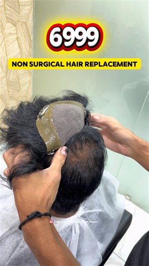 98K views · 2K reactions | ✨ Just ₹6999 for Non-Surgical Hair...