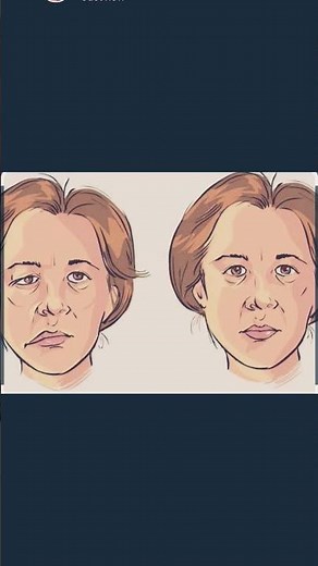 Myasthenia Gravis /tensilon test Edrophonium test #shorts #nursingofficer #norcet #mnsnorcettopper