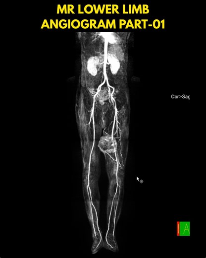 MR Lower Limbs Angiogram Full video link in the comment section #radiology #radiologia #radiography #radiographer #MRI #xray #CTScan #angiogram #angiography #doctor #anatomy #medical #radiologist #radtech #radiologytech #radiologytechnologist #MedicalTech #mritech #mritechnologist | Maruf Bhuiyan The Radiographer