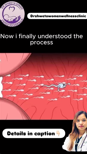 Dr Shweta singh on Instagram: "What is Fertilization? Fertilization is the process where a woman’s egg and a man’s sperm join together to begin the creation of a new life. ⸻ How does fertilization happen? 1. Ovulation: Each month, a mature egg is released from the ovary and enters the fallopian tube. 2. Sperm Journey: After intercourse, millions of sperm travel through the cervix → uterus → fallopian tube. 3. The Moment of Fertilization: • Only one sperm is able to enter the egg. • When the sper