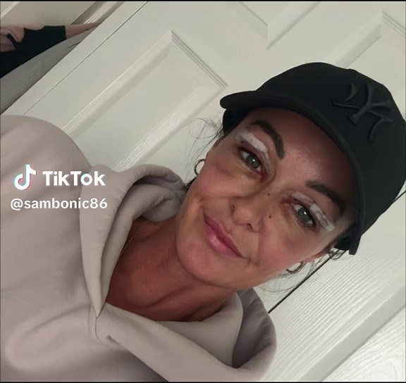 7 Days of Upper Blepharoplasty Recovery Journey
