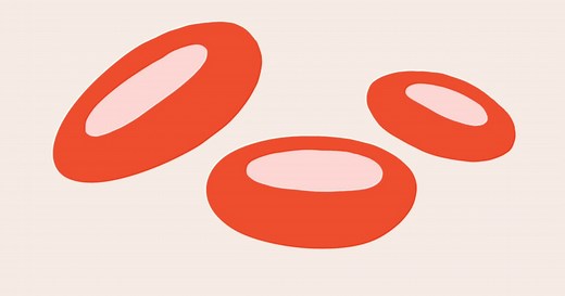 What is Myelodysplastic Syndrome (MDS)?