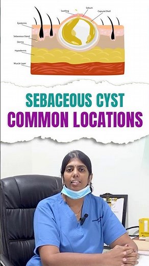 A Lump Under Skin? It Could Be a Sebaceous Cyst #doctor #shorts #drjahnavikoneru