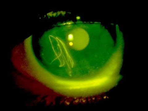 Fluorescein eye stain