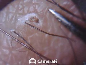 SCAB reveals ingrown hair which is then removed #59