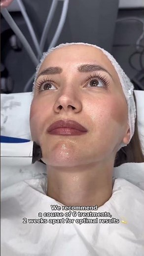 Contoured and defined jawline with Accent Prime | Dr. Medispa