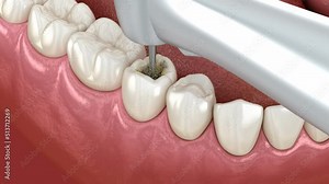 Premolar tooth restoration with composite filling. Medically accurate tooth 3D animation