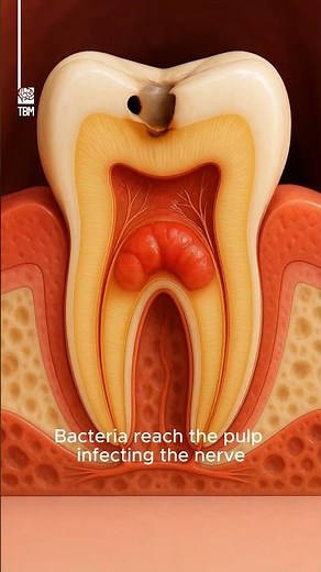 How Tooth Decay Progresses