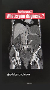276 reactions · 15 shares | Radiology case -27 What is your diagnosis..? | Diwakar Patel | Facebook