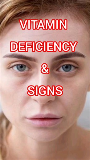 Nutritional Deficiency | Vitamin Deficiency Signs & Symptoms |Vitamin d , vitamin c , Vitamin B12.