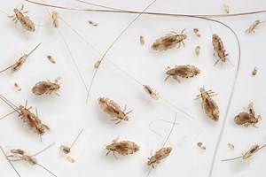 Doctors Share the Most Effective Ways to Banish Lice from Your Body (and Home!)