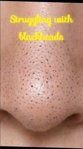 Blackhead nose strip, how to remove black heads
