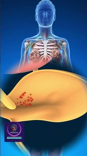 Cystitis of a woman's bladder