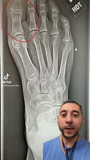 Toe fracture on x-ray 🦶