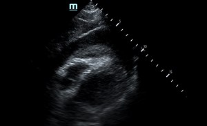 Pericardial Clot on Point-of-Care Ultrasound - JETem