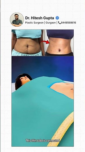 Thinking About Tummy Tuck Or Liposuction? Watch This First