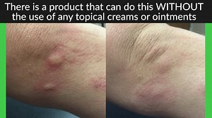 87 reactions · 121 shares | The Bug Bite Thing is a small suction...
