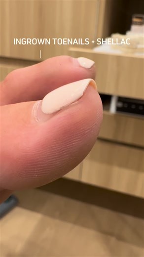 Think you need to strip your Shellac before a Medi-Pedi? Think again! If you’ve got fresh polish, don’t stress — we can work around it or remove it for you. Completely up to you! Book your Medi-Pedi today and give your feet the care (and comfort) they deserve. ✨ 📞 02 9371 7837 | 📧 info@rosebaypodiatry.com.au 💻 www.rosebaypodiatry.com.au #rosebaypodiatry #podiatry #sydneypodiatry #sydneypodiatrist #rosebaypodiatrist #podiatryclinic #sydneypodiatryclinic #skincare #footcare #footcream #medipedi