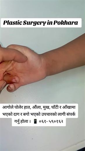 📱 ०६१- ५९०१६२ Best Plastic surgery with experts #Plasticsurgeon #Plasticsurgery #Plasticsurgeryexperts #Doctor #Best #Pokhara #Pokharadiaries #Nepal #Microsurgeon #palpamuser #butwalmuser #chitwanmuser #pokhara #baglung #beni #kusma #lamjung #damauli