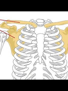 Grade 5 AC separation 3 years after injury, no surgery