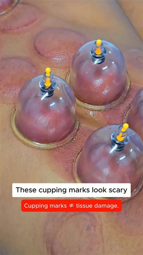 Flexifyme Physiotherapy & Pain Management on Instagram: "Let’s clear the most common doubt about cupping therapy. Those round marks you see after cupping are not bruises, not burns, and not tissue damage. Cupping works by creating gentle negative pressure on the skin. This pressure pulls blood to the surface, increasing local circulation in tight or restricted tissues. What you’re seeing is: • Temporary capillary congestion • Increased blood flow in the area • Release of fascial and muscle tight