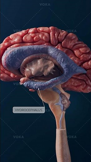 Ependymoma: a rare central nervous system tumor explained in 3D