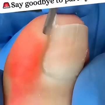 Easily deal with ingrown nails and various complex nail shapes and trimming needs, no tearing, no pain, and smoother trimming! | HZCNR | Facebook