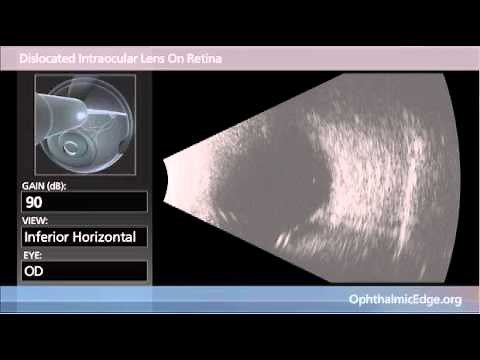 Dislocated Intraocular Lens On Retina