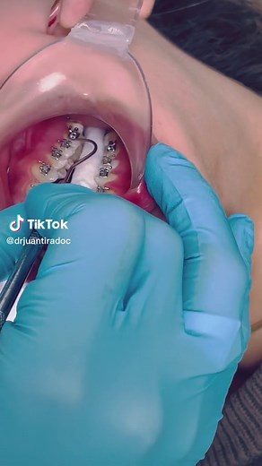 Understanding Dental Procedures with Braces