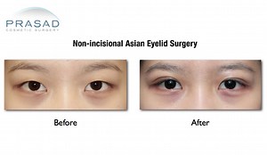 Asian Double Eyelid Surgery:  How to Achieve a Natural Looking Crease