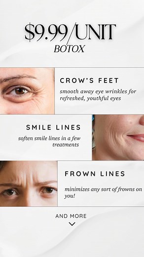 𝐅𝐥𝐚𝐰𝐥𝐞𝐬𝐬 𝐁𝐨𝐭𝐨𝐱 𝐟𝐨𝐫 𝐉𝐮𝐬𝐭 $𝟗.𝟗𝟗/𝐔𝐧𝐢𝐭 – 𝐅𝐫𝐨𝐦 𝐚 𝐓𝐫𝐮𝐬𝐭𝐞𝐝 𝐄𝐱𝐩𝐞𝐫𝐭 Want smooth, natural-looking results without the “frozen” look? At 𝐂𝐞𝐧𝐭𝐞𝐫 𝐟𝐨𝐫 𝐌𝐞𝐝𝐢𝐜𝐚𝐥 𝐀𝐞𝐬𝐭𝐡𝐞𝐭𝐢𝐜𝐬, Nurse Kylie delivers precise Botox treatments designed to enhance—not erase—your expressions. 𝐖𝐡𝐲 𝐂𝐡𝐨𝐨𝐬𝐞 𝐂𝐞𝐧𝐭𝐞𝐫 𝐟𝐨𝐫 𝐌𝐞𝐝𝐢𝐜𝐚𝐥 𝐀𝐞𝐬𝐭𝐡𝐞𝐭𝐢𝐜𝐬? ⭐ 𝐄𝐥𝐢𝐭𝐞 𝐈𝐧𝐣𝐞𝐜𝐭𝐨𝐫 𝐄𝐱𝐩𝐞𝐫𝐭𝐢𝐬𝐞 – Nurse Kylie specializes in advanced Botox techniqu